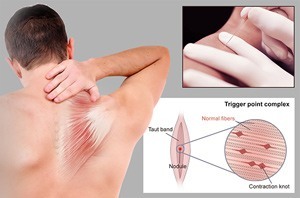 Dry Needling